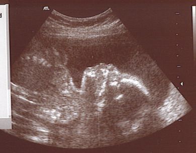 Echo in de zwangerschap